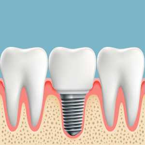 North Carolina Dental Implants